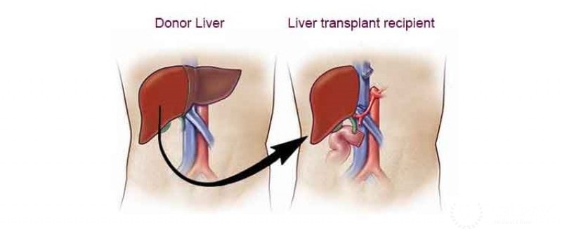 cost of liver transplant